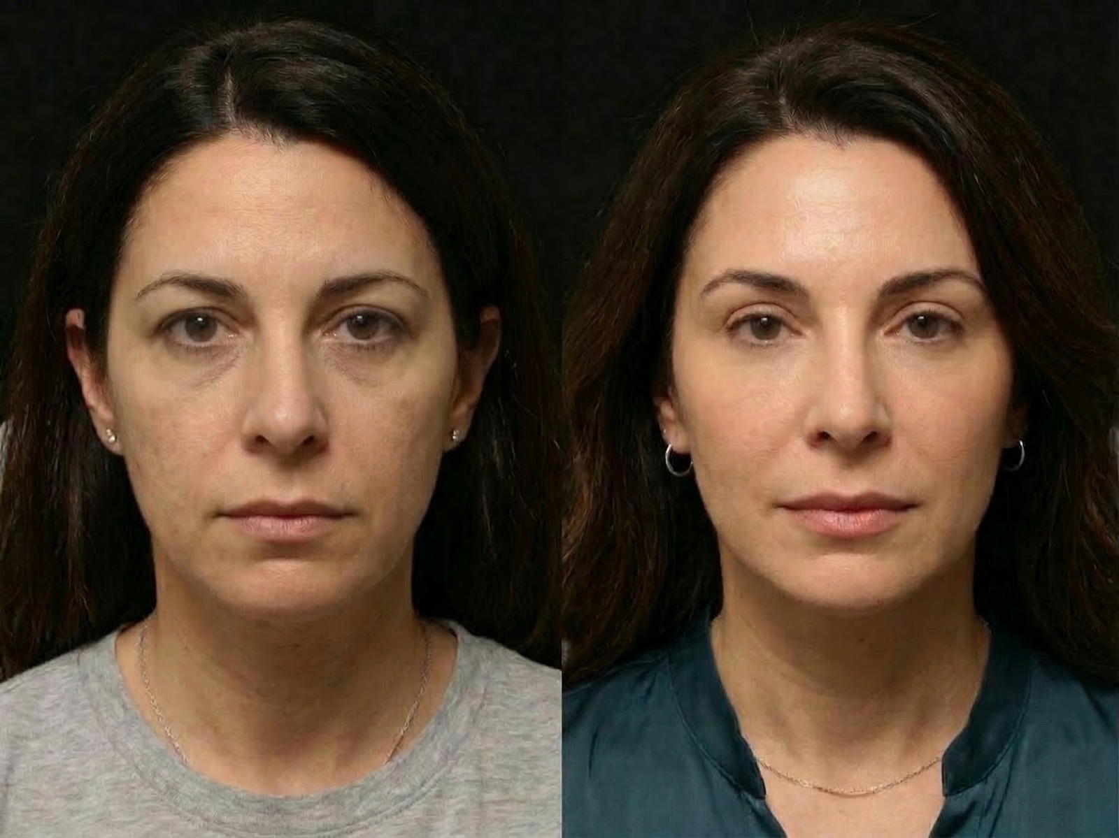 Sample SurgeryViz before-and-after preview